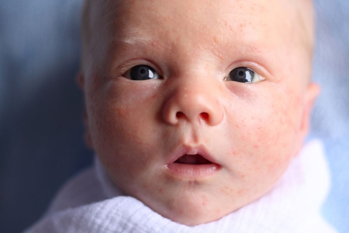 Featured image for “Baby Acne: Breast Milk as a Potential Cure”
